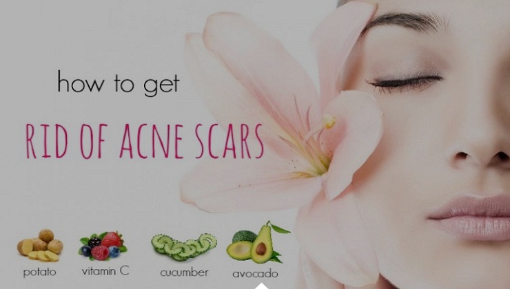 38 Tips on how to get rid of Acne Scars fast and Naturally